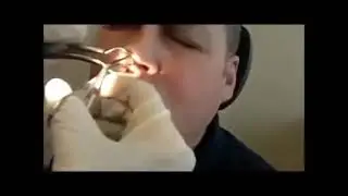 Огромный прыщ. Жесть.Смотреть до конца!!!