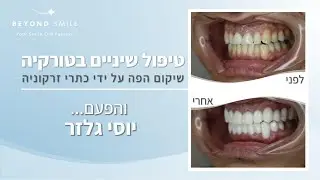 טיפולי שיניים בטורקיה עם ביונד סמייל - החיוך החדש של יוסי