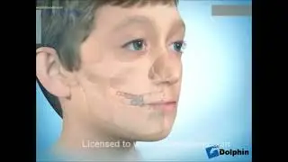 MÁSCARA DE PROTRACCIÓN
