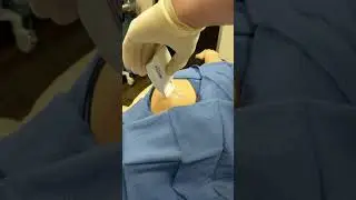 Prineo Wound Dressing after Excision of Skin Cancer