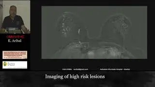 BREAST HIGH RISK LESIONS
