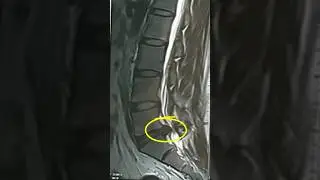 Lumbar disc Extrusion? Don’t go for surgery  #backpainrelief #sciatica #extrusion #lumbarspine
