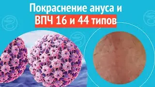 🥵 Покраснение ануса и ВПЧ 16 и 44 типов. Клинический случай №1229
