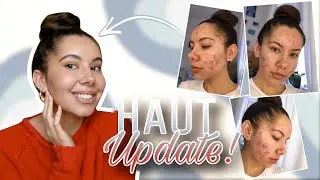 HAUT UPDATE!✨ - 6 Monate nach Aknenormin Therapie💊 | Valeria Greb