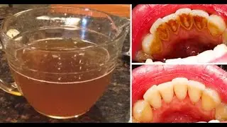 This lady applying this ingredients and see his plaque gone forever