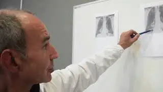 A pneumonia