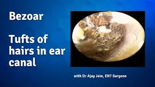 Bezoar | So many hairs in ear