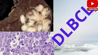 Diffuse large B cell Lymphoma|What is diffuse large B cell lymphoma?Review- usmle,neetpg, plab,fmge