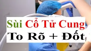 Sùi Mào Gà Cực Rõ & To Bên Trong Cổ Tử Cung, Xử Lý Đốt Dao Điện Cho Bệnh Nhân | Bác Sĩ Sắc