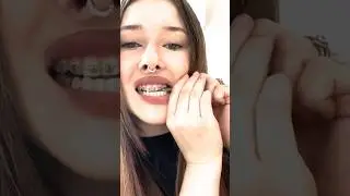 Reasons why you Shouldn't take your own Braces off