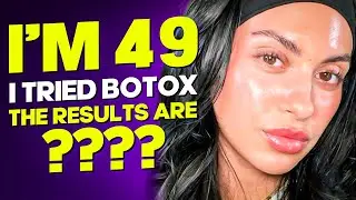 Botox or Microneedling: Which is Better For Over 50 Skin?