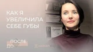 КАК Я УВЕЛИЧИЛА ГУБЫ. Увеличение губ. Результат до и после.