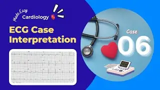 ECG Case Interpretation | Atrial Fibrillation | Alcoholic Cardiomyopathy | Abnormal ECG | Case 06