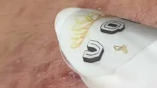 Acne Treatment New 2025 | Blackheads & Whiteheads Removal  Mimi channel 032