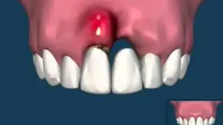 bridge / implant dentaire