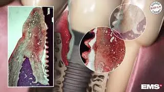 Peri-Implantitis and its prevention in 3D