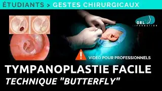 Tympanoplasty | Butterfly technique