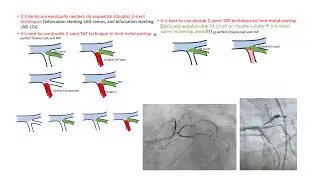 Left main trifurcation strategies