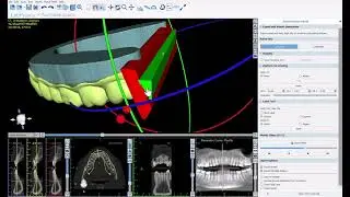 BSP V4.13: Design and Export Aligners for Direct Aligner Printing