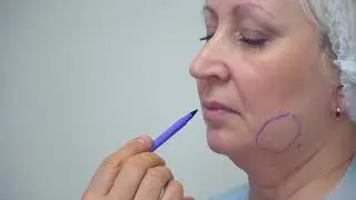 Лазерный липолиз подбородка