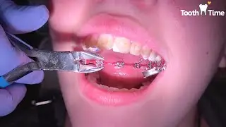 Braces Off - Tooth Time Family Dentistry New Braunfels