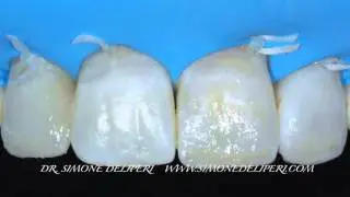 Post-orthodontic Direct Composite Veneers- Dr Simone Deliperi