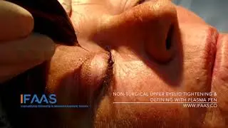 IFAAS Exclusive: Non-surgical Eyelid Tightening with Plasma Pen Procedure