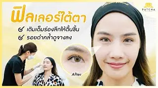 ใต้ตาคล้ำ หน้าดูโทรม แก้ปัญหาด้วยฟิลเลอร์