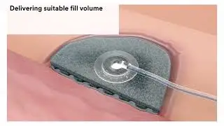 How to use: 3M™ V.A.C.® Ulta 4 Therapy System