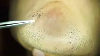Hair removal asmr pull out with Tweezers  Satisfying pull out beard 10min 202408c