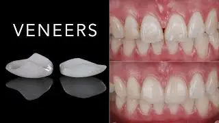 Ceramic Veneers for upper central anterior teeth. Reshape and close the midline gap