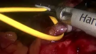 Aneurism of the Splenic Artery: Laparoscopic Splenectomy