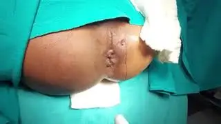 ANAL DILATATION BY DILATORS - DR.SACHIN GUPTA M.S.(AYU) - +919419135050.
