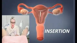 IUD Insertion |Copper & Hormonal IUDs| Prevent Pregnancy|  Intrauterine Devices Placement
