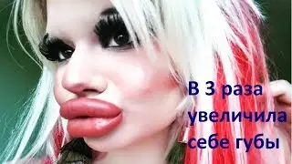 Увеличила губы в 3 раза