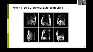 AI for the Most Accurate Radiotherapy of Mobile Tumours in the Alberta linac-MR - Dr. Jihyun Yun