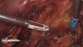 Complicated salpingo-oophorectomy: Technique