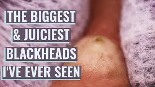The Biggest & Juiciest Blackheads I've Ever Seen (Amilios First Session Ever On His Back)