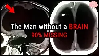 Hydrocephalus & The Man without a BRAIN