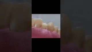 class IV composite restoration حشو تجميلي