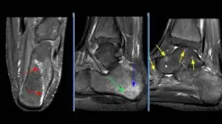 MRI Ankle Case 22