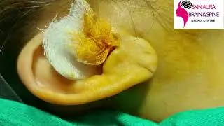 #earloberepair #earprotection #earpiercing