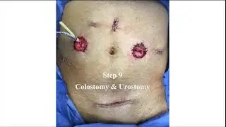 V13-03: Robot-Assisted Total Pelvic Exenteration: Indications and Technical Considerations