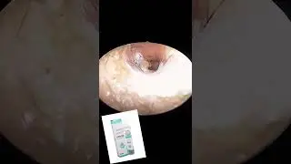Cause of white deposits in ear canal | Ciprofloxacin ear drops