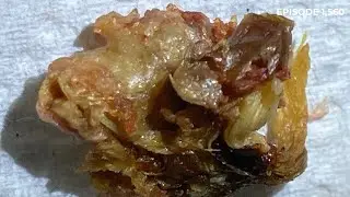 1,560 - Complex Grade III Keratosis Obturans Removal