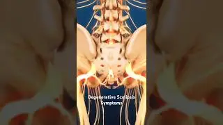 Degenerative Scoliosis Symptoms