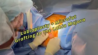 Labiaplasty + Fat Grafting to the Labia Majora