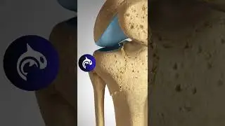 See how a Tibial Plateau Fracture is surgically fixed in 4K 3D animation.