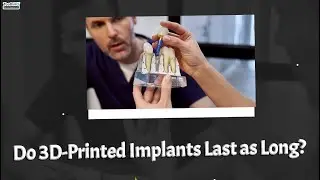 Do 3D-Printed Implants Last as Long?