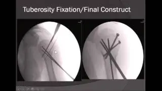 Proximal humerus fractures: practical tips and techniques for optimal management